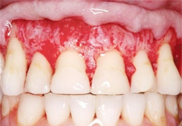 Hậu họa khôn lường từ miếng dán trắng tẩy răng